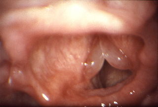 Laringita cronică edematoasă-polipoză (edemul rinitei)