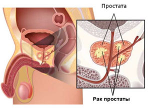 Obstrucția urinării la bărbați