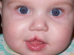 Заяча губа у новонароджених лікування, профілактика