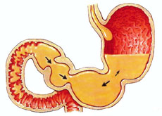 Astmul gastric