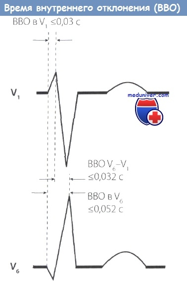 Barb s egy EKG-