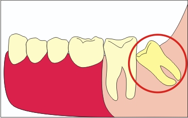 Зуби мудрості, стратити чи помилувати