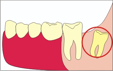 Зуби мудрості, стратити чи помилувати