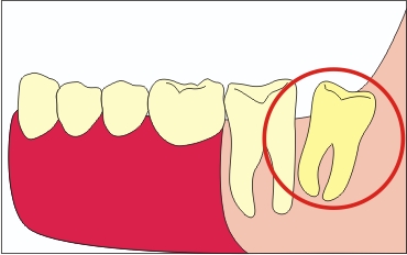 Зуби мудрості, стратити чи помилувати