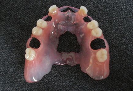 Denture detașabil nailon - preț și fotografie