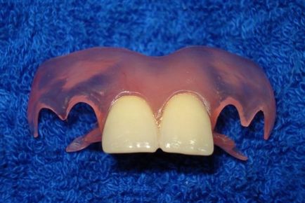 Зубні протези знімні нейлонові - ціна і фото