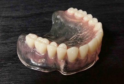 Denture detașabil nailon - preț și fotografie