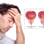 Adenomul prostatei de gradul III și tratamentul prostatitei de 1 grad