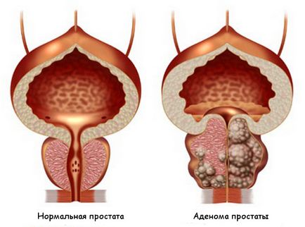 Adenomul prostatei de gradul III și tratamentul prostatitei de 1 grad