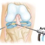 Arhitectura artroscopică a reviziilor comune ale genunchiului