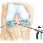 Artroszkópos térdízület rehabilitációs vélemények