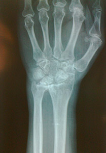 Artroza articulației încheieturii mâinii - simptome și tratament 1
