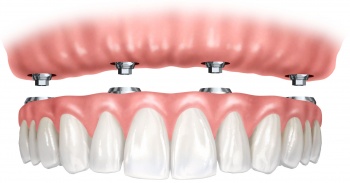Авторська стоматологія імплантація при повній відсутності зубів