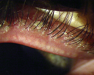 Блефарит - захворювання очей
