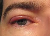 Blefarita - boala oculară