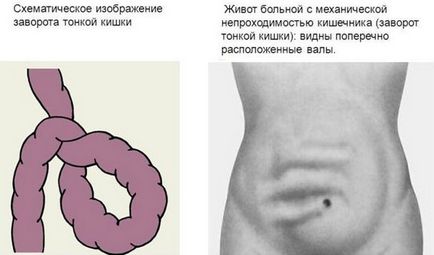Intestinele din durerile abdomenului inferior, natura durerii, cauzele și tratamentul