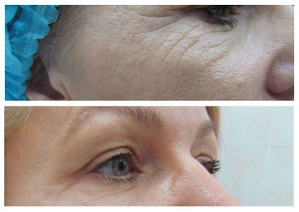 Fața de Botox, prețurile de injecție în ochi, frunte, sprancene, palme, buze în St. Petersburg, comentarii despre