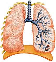 Bronchitis - leírása, a tünetek és a kezelés a betegség