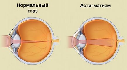 Ce trebuie făcut dacă un copil la vârsta de 1 an este diagnosticat cu astigmatism, boală oculară