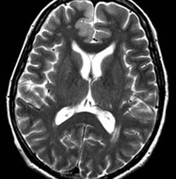 Ce sunt leziunile cerebrale și semnele?