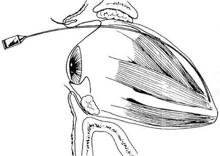 Ce este o blocadă retrobulbarică, despre bolile oculare?