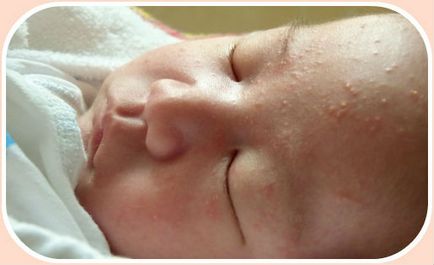 Цвітіння новонароджених причини і лікування в домашніх умовах