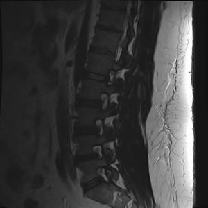 Modificări degenerative-distrofice ale coloanei vertebrale cervicale, toracice, lombare,