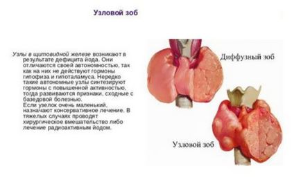 Дифузно-вузловий зоб щитовидної залози