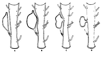 Diverticulul uretrei 2