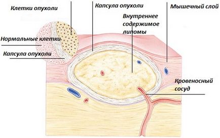 Jóindulatú lágyrészdaganatok - faj fejlesztési mechanizmussal