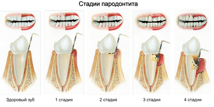 Ефективний метод лікування пародонтиту з застосуванням діодного лазера doctor smile, nord dental