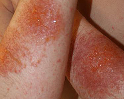 Eczemă - cauze, simptome, diagnostic și tratament