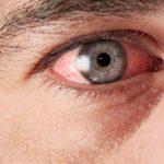 Енуклеація очного яблука операція з видалення ока у людини - як проводиться