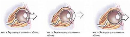 Enuclearea operației globului ocular pentru a îndepărta ochiul la om - cum se efectuează