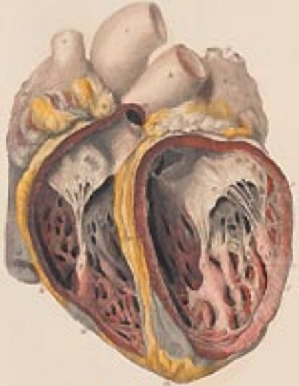 Fibroelastoza endocardică