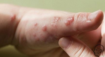 Herpesul pe mâini și degete - cauze, tratament și simptome (foto)