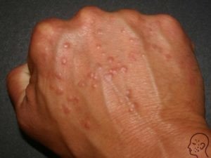 Herpesz kéz és az ujjak - okai, tünetei és kezelése (fotó)