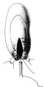 Hydronephrosis, Yuri Eduardovici Rudin