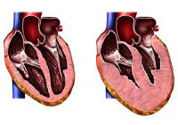 Cardiomiopatia hipertrofică - cauze, simptome, diagnostic și tratament