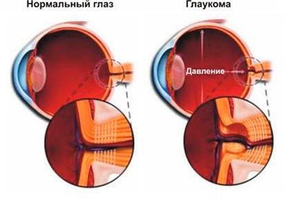 Глаукома катаракта лікування народними засобами народні засоби корекція зору