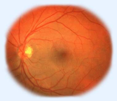 Afecțiuni oftalmice ale diabetului zaharat