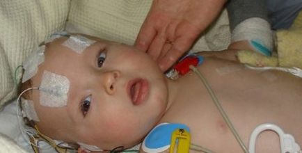 Meningita purulentă la copii Simptome și cauze, consecințe pentru nou-născuți