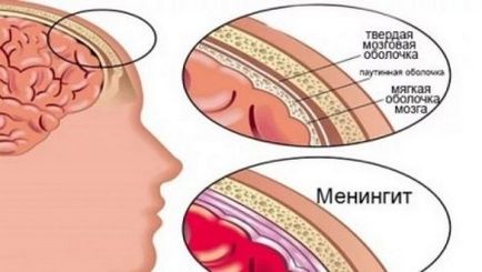 Гнійний менінгіт у дітей симптоми і причини, наслідки для новонароджених