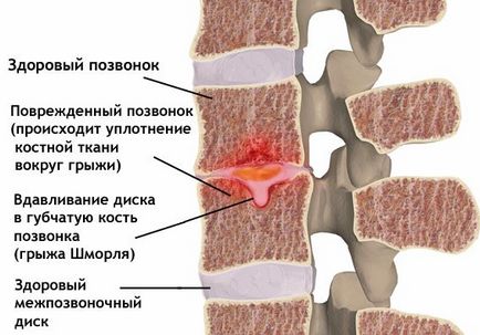 Грижа Шморля - лікування, симптоми і відновлювальна гімнастика