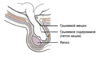 Грижа яєчка анатомо-фізіологічні передумови для її освіти, симптоми і лікування