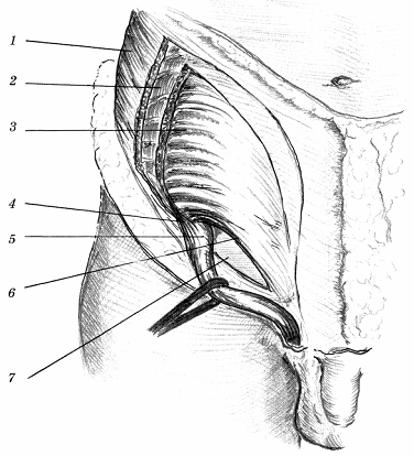 Hernia musculară abdominală oblică internă și aponeuroza sa