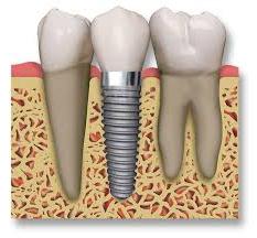 Імплантанти зубів відгуки пацієнтів про операцію