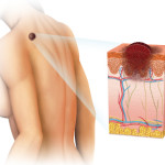 Inovații în tratamentul melanomului, centrul medical al conacului, diagnosticul modular și tratamentul în Israel