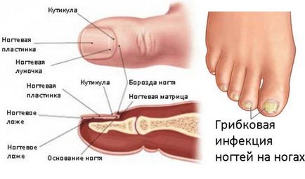 Як лікувати грибок нігтів на ногах