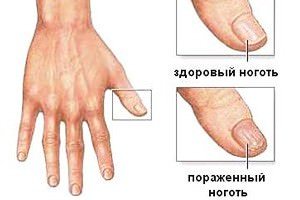 Як лікувати грибок нігтів в домашніх умовах (натуральні, народні методи лікування)